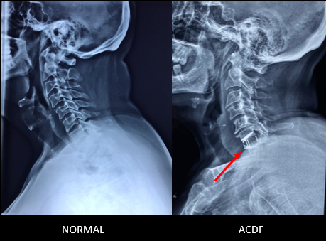 Anterior Cervical Discectomy and Fusion (ACDF) - Best Spine Surgeon in  Mumbai | Top Spine surgeon in India